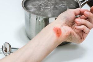 Where Do Burn Accidents Occur in Redding